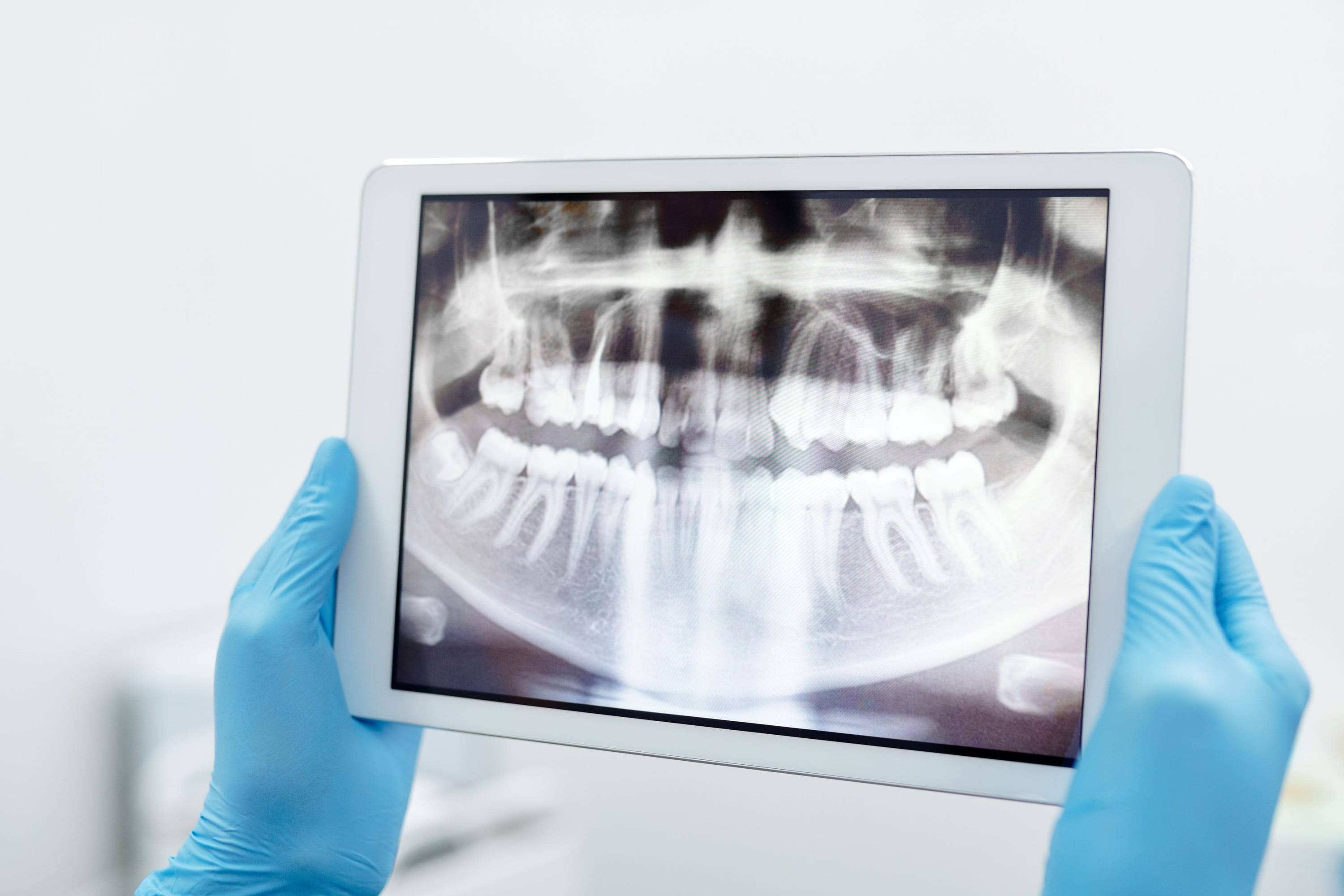 Panorama-Röntgenbild auf einem Tablet, gehalten mit blauen Handschuhen