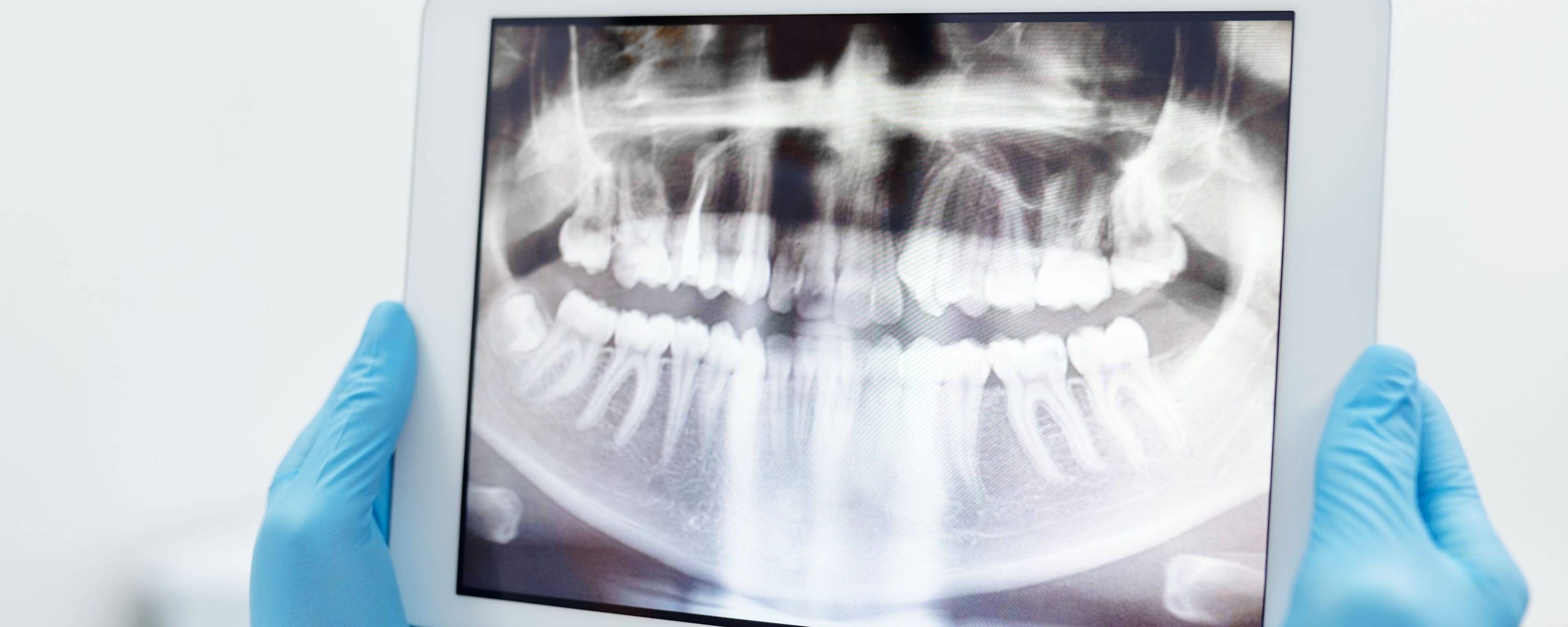 Panorama-Röntgenbild auf einem Tablet, gehalten mit blauen Handschuhen
